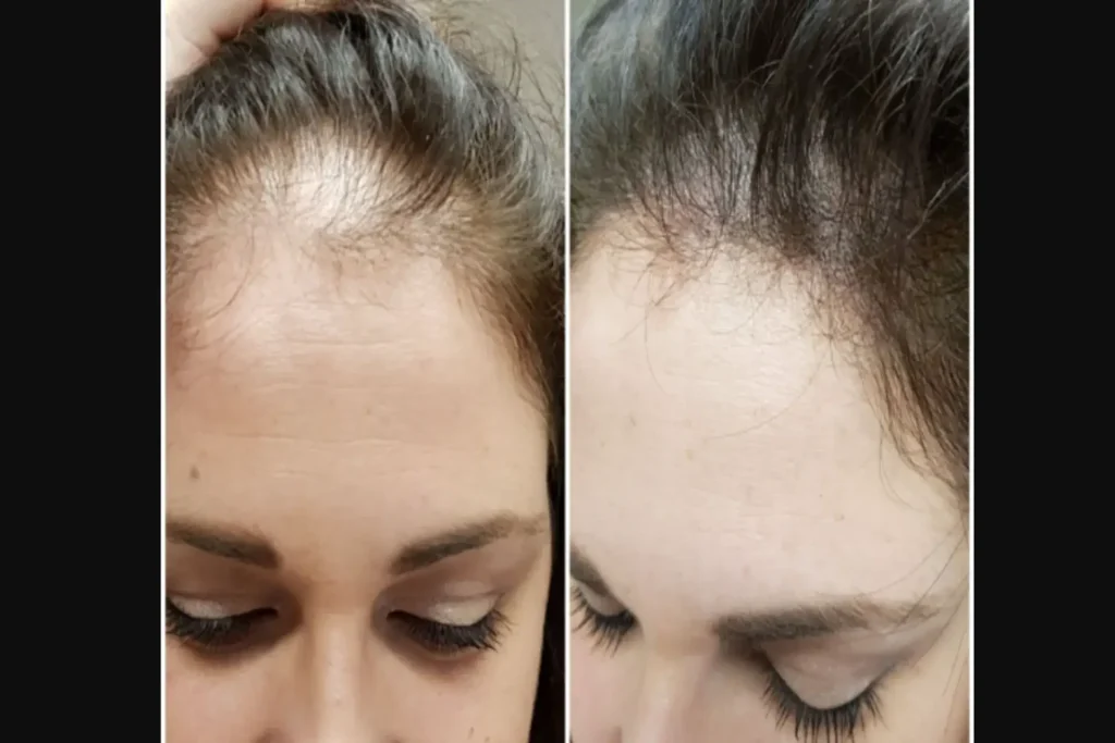 Dermopigmentazione capelli